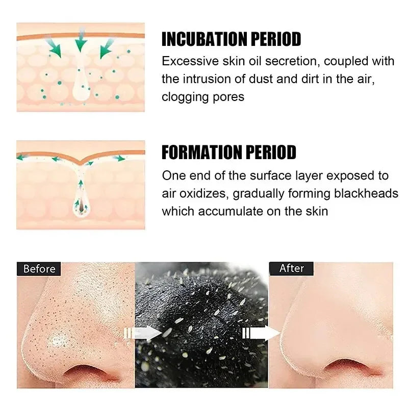 60g Blackhead Removing Nasal Mask Mild And Non Irritating To Shrink Pores And Remove Blackhead And Acne Tearing Facial Mask